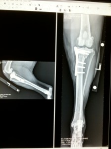 Annie's bionic leg